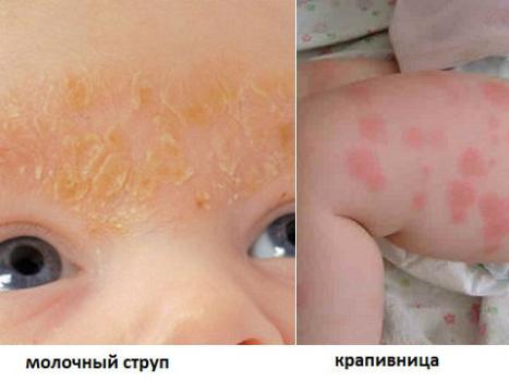 Аллергия у ребенка: как определить и чем помочь малышу